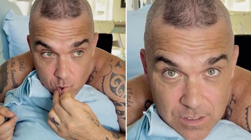 Robbie Williams podstúpil transplantáciu vlasov